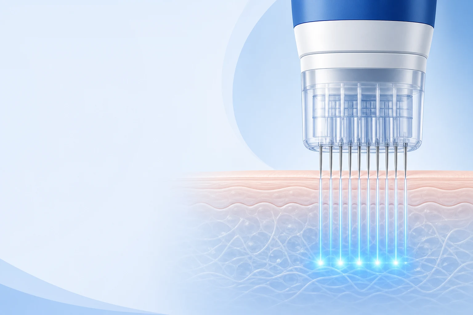 Diagram of fine microneedles creating micro-channels in the skin that trigger a collagen response