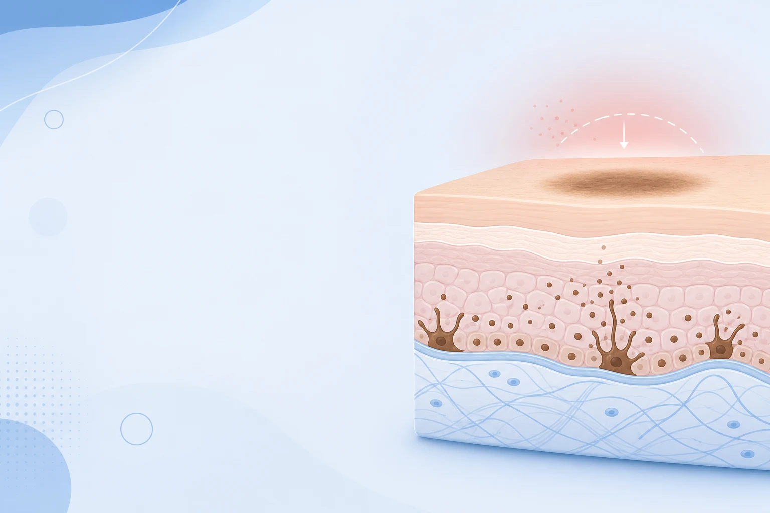 Diagram of inflammation triggering pigment cells to deposit a flat brown mark