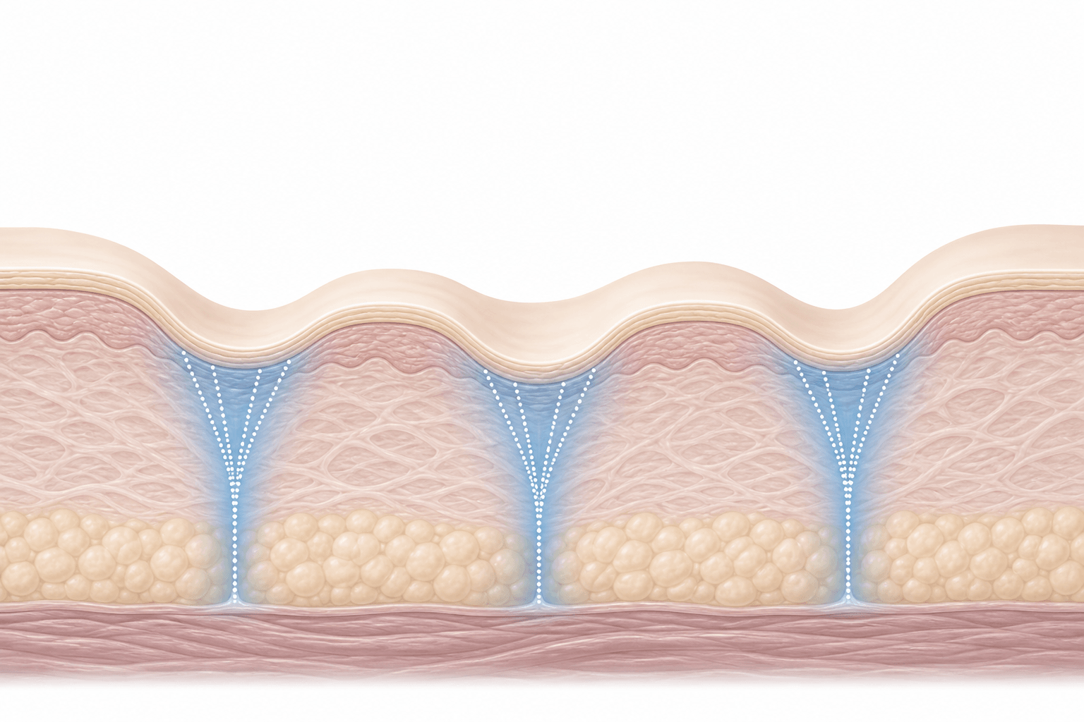 Illustration showing rolling acne scars and the fibrous bands tethering the skin surface downward