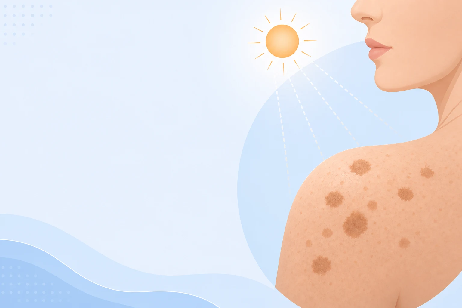 Diagram of well-defined sun spots on the skin caused by cumulative UV exposure