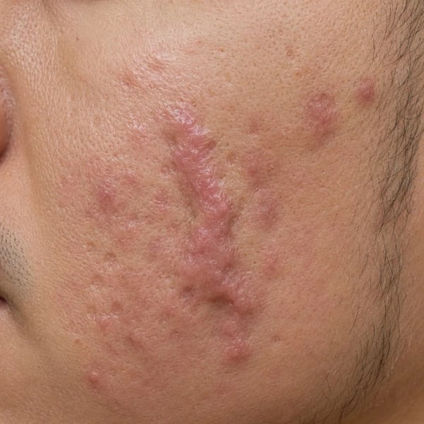 Close-up of atrophic acne marks showing red and brown post-inflammatory discolouration on the cheek