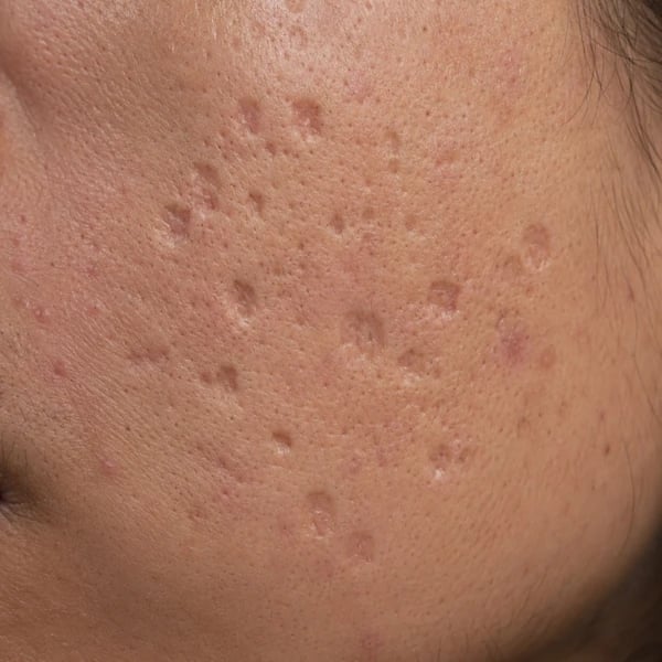 Close-up of boxcar acne scars showing wide, defined-edge depressions on the cheek