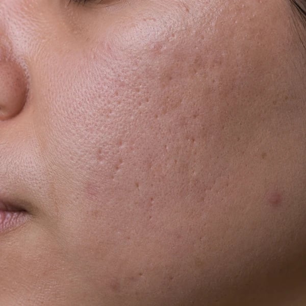 Close-up of ice pick acne scars showing narrow, deep pitted channels on the cheek