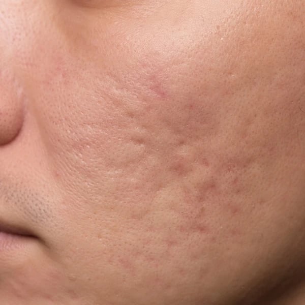 Close-up of rolling acne scars showing soft wave-like depressions on the cheek
