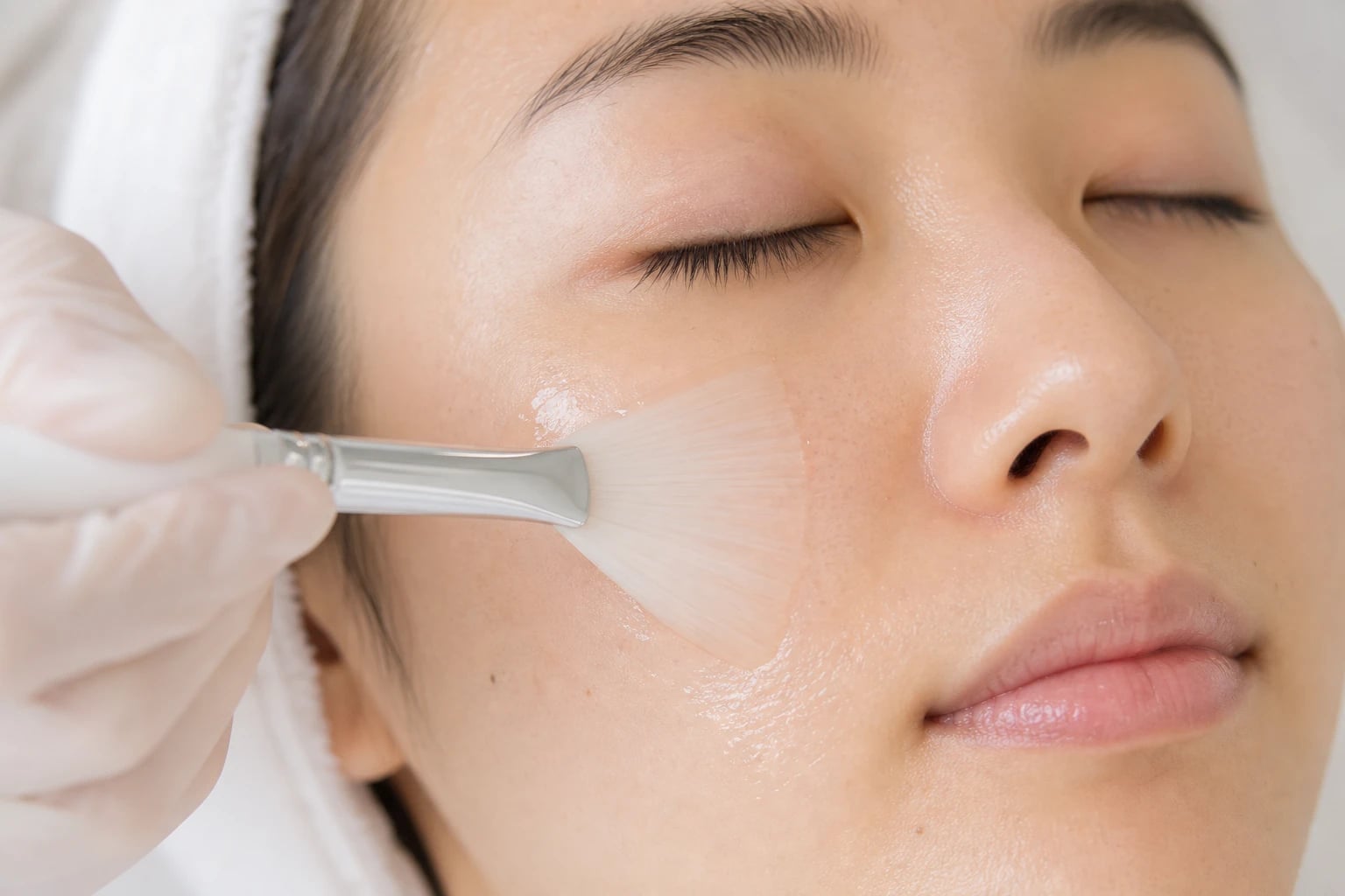 Chemical Peel treatment