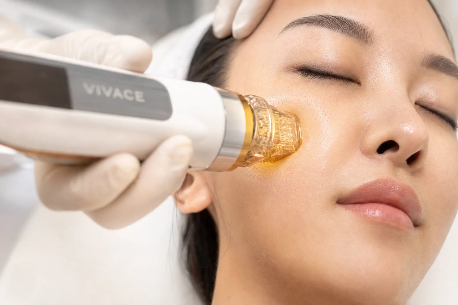 RF Microneedling treatment