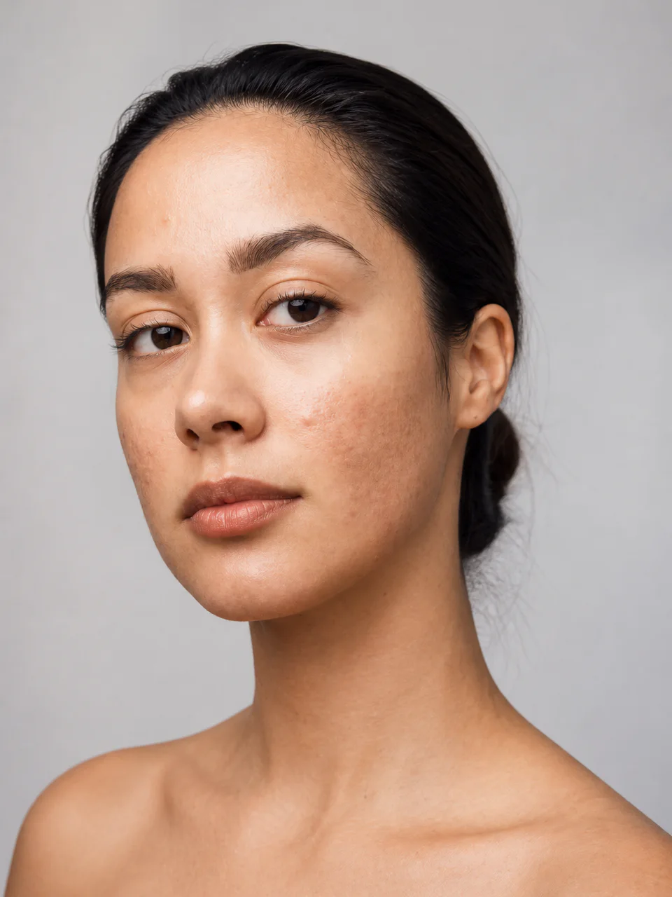 Southeast Asian woman with flat post-inflammatory hyperpigmentation marks on her cheeks