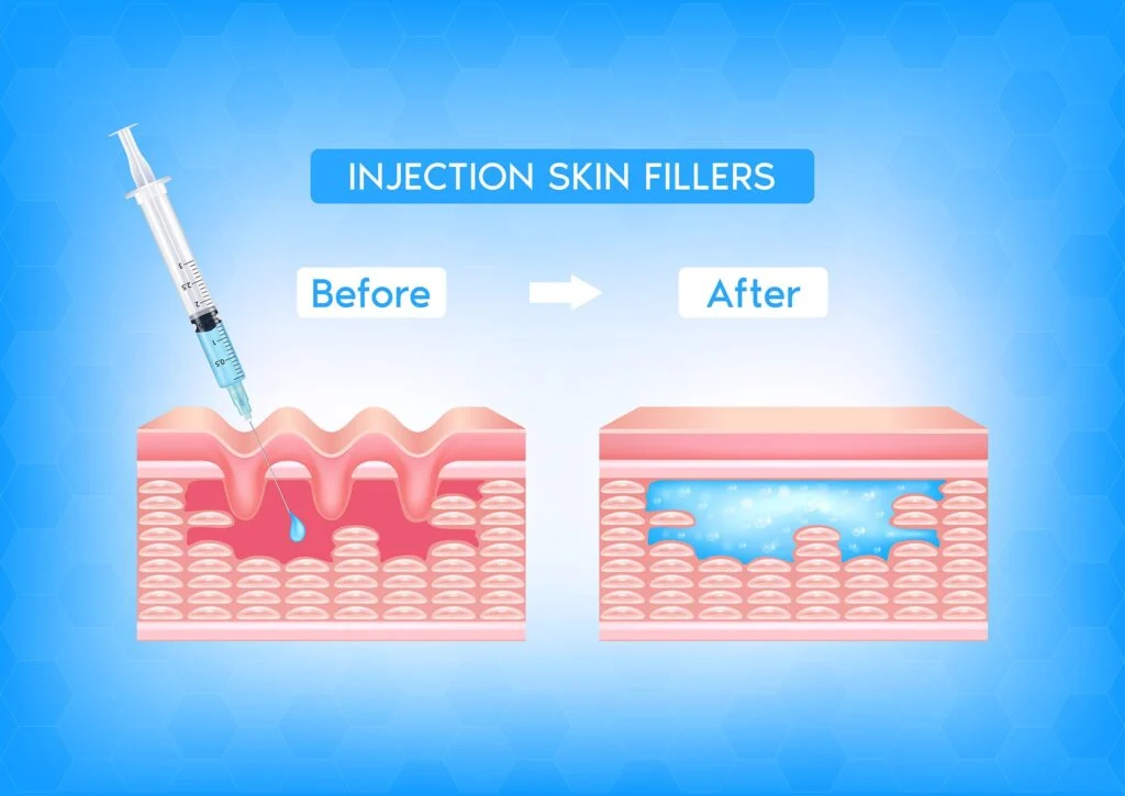 dermal fillers function illustration
